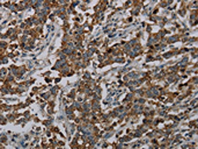 The image on the left is immunohistochemistry of paraffin-embedded Human liver cancer tissue using CSB-PA285771(CFLAR Antibody) at dilution 1/20, on the right is treated with synthetic peptide. (Original magnification: ×200)
