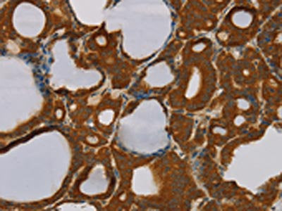 The image on the left is immunohistochemistry of paraffin-embedded Human thyroid cancer tissue using CSB-PA285823(PARP3 Antibody) at dilution 1/40, on the right is treated with fusion protein. (Original magnification: ×200)