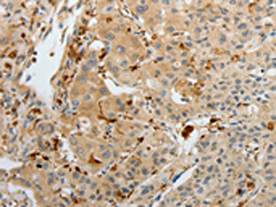 The image on the left is immunohistochemistry of paraffin-embedded Human cervical cancer tissue using CSB-PA285910(F13A1 Antibody) at dilution 1/15, on the right is treated with fusion protein. (Original magnification: X200)