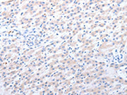 The image on the left is immunohistochemistry of paraffin-embedded Human liver cancer tissue using CSB-PA286031(ALDH1A1/ALDH1A2/ALDH1A3 Antibody) at dilution 1/40, on the right is treated with fusion protein. (Original magnification: ×200)