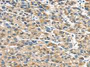 The image on the left is immunohistochemistry of paraffin-embedded Human liver cancer tissue using CSB-PA286159(GLP2R Antibody) at dilution 1/30, on the right is treated with fusion protein. (Original magnification: ×200)