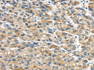 The image on the left is immunohistochemistry of paraffin-embedded Human liver cancer tissue using CSB-PA286159(GLP2R Antibody) at dilution 1/30, on the right is treated with fusion protein. (Original magnification: ×200)