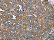 The image on the left is immunohistochemistry of paraffin-embedded Human cervical cancer tissue using CSB-PA286186(FAIM2 Antibody) at dilution 1/40, on the right is treated with fusion protein. (Original magnification: ×200)