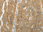The image on the left is immunohistochemistry of paraffin-embedded Human ovarian cancer tissue using CSB-PA286198(MAP4K5 Antibody) at dilution 1/10, on the right is treated with fusion protein. (Original magnification: ×200)