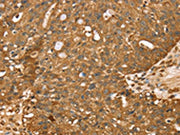 The image on the left is immunohistochemistry of paraffin-embedded Human breast cancer tissue using CSB-PA286218(STARD5 Antibody) at dilution 1/40, on the right is treated with synthetic peptide. (Original magnification: ×200)