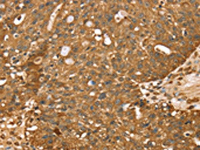 The image on the left is immunohistochemistry of paraffin-embedded Human breast cancer tissue using CSB-PA286218(STARD5 Antibody) at dilution 1/40, on the right is treated with synthetic peptide. (Original magnification: ×200)