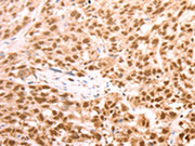 The image on the left is immunohistochemistry of paraffin-embedded Human esophagus cancer tissue using CSB-PA286404(AMD1 Antibody) at dilution 1/25, on the right is treated with synthetic peptide. (Original magnification: ×200)