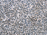 The image on the left is immunohistochemistry of paraffin-embedded Human ovarian cancer tissue using CSB-PA286755(TONSL Antibody) at dilution 1/60, on the right is treated with fusion protein. (Original magnification: ×200)