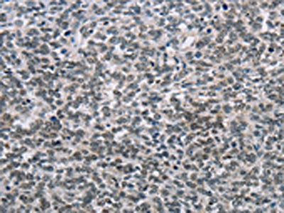 The image on the left is immunohistochemistry of paraffin-embedded Human ovarian cancer tissue using CSB-PA286755(TONSL Antibody) at dilution 1/60, on the right is treated with fusion protein. (Original magnification: ×200)