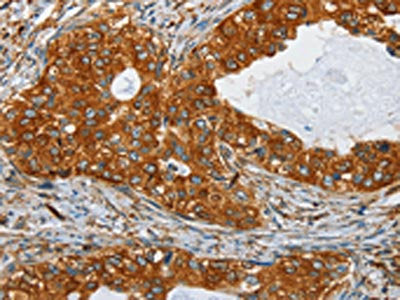 The image on the left is immunohistochemistry of paraffin-embedded Human cervical cancer tissue using CSB-PA286864(SEPT9 Antibody) at dilution 1/25, on the right is treated with fusion protein. (Original magnification: ×200)