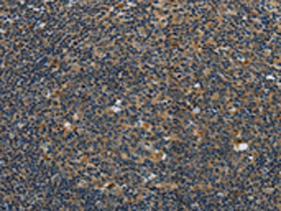 The image on the left is immunohistochemistry of paraffin-embedded Human tonsil tissue using CSB-PA286879(SYN1 Antibody) at dilution 1/40, on the right is treated with synthetic peptide. (Original magnification: ×200)