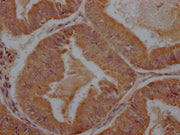 IHC image of CSB-PA28699A0Rb diluted at 1:100 and staining in paraffin-embedded human endometrial cancer performed on a Leica BondTM system. After dewaxing and hydration, antigen retrieval was mediated by high pressure in a citrate buffer (pH 6.0)...