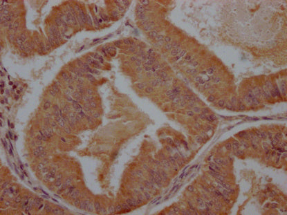 IHC image of CSB-PA28699A0Rb diluted at 1:100 and staining in paraffin-embedded human endometrial cancer performed on a Leica BondTM system. After dewaxing and hydration, antigen retrieval was mediated by high pressure in a citrate buffer (pH 6.0)...