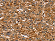The image on the left is immunohistochemistry of paraffin-embedded Human liver cancer tissue using CSB-PA287152(SRGN Antibody) at dilution 1/20, on the right is treated with fusion protein. (Original magnification: ×200)