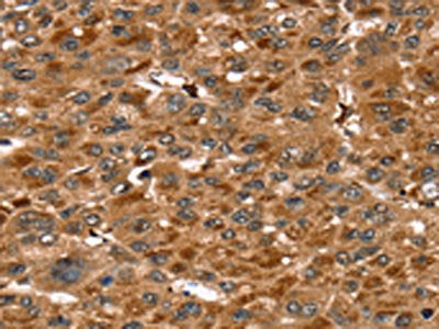 The image on the left is immunohistochemistry of paraffin-embedded Human liver cancer tissue using CSB-PA287152(SRGN Antibody) at dilution 1/20, on the right is treated with fusion protein. (Original magnification: ×200)