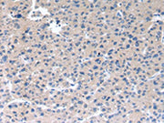 The image on the left is immunohistochemistry of paraffin-embedded Human liver cancer tissue using CSB-PA287240(RAB2A Antibody) at dilution 1/40, on the right is treated with synthetic peptide. (Original magnification: ×200)