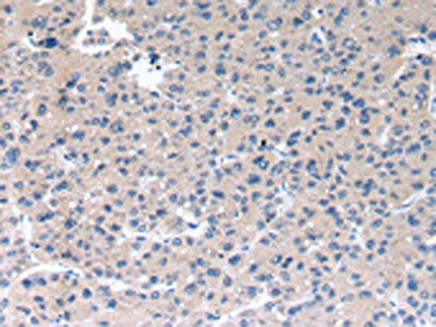 The image on the left is immunohistochemistry of paraffin-embedded Human liver cancer tissue using CSB-PA287240(RAB2A Antibody) at dilution 1/40, on the right is treated with synthetic peptide. (Original magnification: ×200)