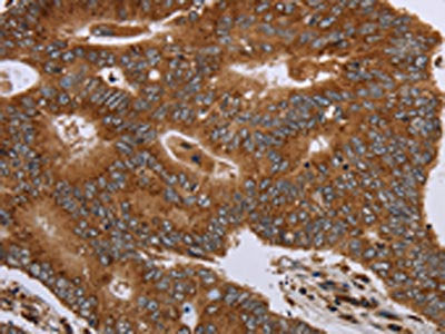 The image on the left is immunohistochemistry of paraffin-embedded Human colon cancer tissue using CSB-PA287281(HSD17B4 Antibody) at dilution 1/20, on the right is treated with fusion protein. (Original magnification: ×200)