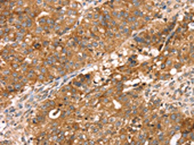 The image on the left is immunohistochemistry of paraffin-embedded Human breast cancer tissue using CSB-PA287378(PDLIM4 Antibody) at dilution 1/30, on the right is treated with fusion protein. (Original magnification: ×200)