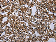 The image on the left is immunohistochemistry of paraffin-embedded Human prostate cancer tissue using CSB-PA287547(ME1 Antibody) at dilution 1/20, on the right is treated with synthetic peptide. (Original magnification: ×200)