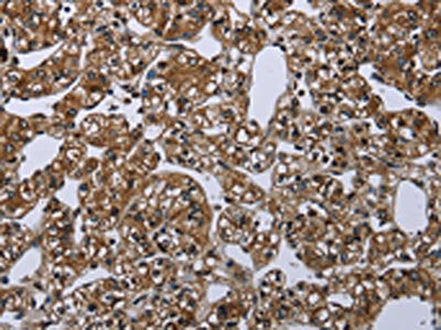 The image on the left is immunohistochemistry of paraffin-embedded Human prostate cancer tissue using CSB-PA287547(ME1 Antibody) at dilution 1/20, on the right is treated with synthetic peptide. (Original magnification: ×200)