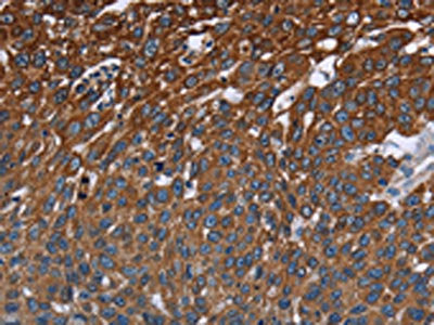 The image on the left is immunohistochemistry of paraffin-embedded Human lung cancer tissue using CSB-PA287660(FCGR3A Antibody) at dilution 1/40, on the right is treated with fusion protein. (Original magnification: ×200)
