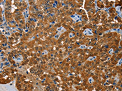 The image on the left is immunohistochemistry of paraffin-embedded Human thyroid cancer tissue using CSB-PA287728(ACY1 Antibody) at dilution 1/20, on the right is treated with fusion protein. (Original magnification: ×200)