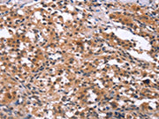 The image on the left is immunohistochemistry of paraffin-embedded Human thyroid cancer tissue using CSB-PA287752(GCKR Antibody) at dilution 1/15, on the right is treated with synthetic peptide. (Original magnification: ×200)