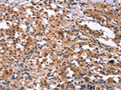 The image on the left is immunohistochemistry of paraffin-embedded Human thyroid cancer tissue using CSB-PA287752(GCKR Antibody) at dilution 1/15, on the right is treated with synthetic peptide. (Original magnification: ×200)