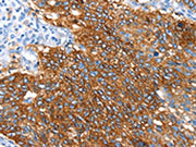The image on the left is immunohistochemistry of paraffin-embedded Human lung cancer tissue using CSB-PA287873(SNX5 Antibody) at dilution 1/30, on the right is treated with synthetic peptide. (Original magnification: ×200)