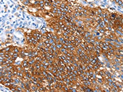 The image on the left is immunohistochemistry of paraffin-embedded Human lung cancer tissue using CSB-PA287873(SNX5 Antibody) at dilution 1/30, on the right is treated with synthetic peptide. (Original magnification: ×200)