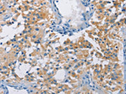 The image on the left is immunohistochemistry of paraffin-embedded Human thyroid cancer tissue using CSB-PA288252(ATP6AP2 Antibody) at dilution 1/40, on the right is treated with fusion protein. (Original magnification: ×200)