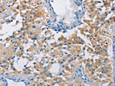 The image on the left is immunohistochemistry of paraffin-embedded Human thyroid cancer tissue using CSB-PA288252(ATP6AP2 Antibody) at dilution 1/40, on the right is treated with fusion protein. (Original magnification: ×200)