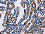 The image on the left is immunohistochemistry of paraffin-embedded Human thyroid cancer tissue using CSB-PA288314(FHIT Antibody) at dilution 1/25, on the right is treated with fusion protein. (Original magnification: ×200)