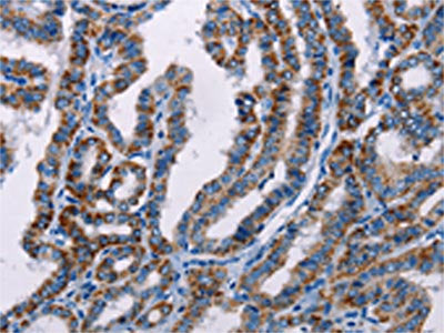 The image on the left is immunohistochemistry of paraffin-embedded Human thyroid cancer tissue using CSB-PA288314(FHIT Antibody) at dilution 1/25, on the right is treated with fusion protein. (Original magnification: ×200)