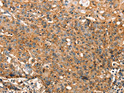The image on the left is immunohistochemistry of paraffin-embedded Human gastic cancer tissue using CSB-PA288472(STK17A Antibody) at dilution 1/25, on the right is treated with synthetic peptide. (Original magnification: ×200)
