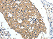 The image on the left is immunohistochemistry of paraffin-embedded Human breast cancer tissue using CSB-PA288553(FSHR Antibody) at dilution 1/70, on the right is treated with fusion protein. (Original magnification: ×200)
