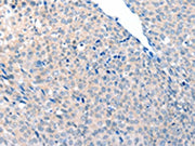 The image on the left is immunohistochemistry of paraffin-embedded Human cervical cancer tissue using CSB-PA288592(ACOT8 Antibody) at dilution 1/20, on the right is treated with fusion protein. (Original magnification: ×200)