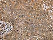 The image on the left is immunohistochemistry of paraffin-embedded Human cervical cancer tissue using CSB-PA288812(CLEC16A Antibody) at dilution 1/45, on the right is treated with synthetic peptide. (Original magnification: ×200)
