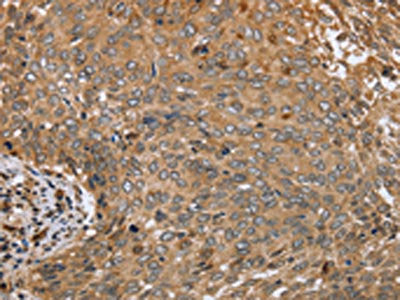 The image on the left is immunohistochemistry of paraffin-embedded Human cervical cancer tissue using CSB-PA288812(CLEC16A Antibody) at dilution 1/45, on the right is treated with synthetic peptide. (Original magnification: ×200)