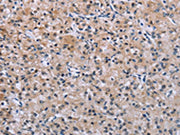 The image on the left is immunohistochemistry of paraffin-embedded Human prostate cancer tissue using CSB-PA288814(SLC1A6 Antibody) at dilution 1/40, on the right is treated with synthetic peptide. (Original magnification: ×200)