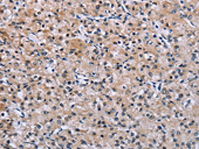 The image on the left is immunohistochemistry of paraffin-embedded Human prostate cancer tissue using CSB-PA288814(SLC1A6 Antibody) at dilution 1/40, on the right is treated with synthetic peptide. (Original magnification: ×200)
