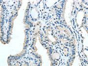 The image on the left is immunohistochemistry of paraffin-embedded Human thyroid cancer tissue using CSB-PA288894(TRIB1 Antibody) at dilution 1/20, on the right is treated with synthetic peptide. (Original magnification: ×200)