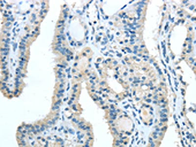 The image on the left is immunohistochemistry of paraffin-embedded Human thyroid cancer tissue using CSB-PA288894(TRIB1 Antibody) at dilution 1/20, on the right is treated with synthetic peptide. (Original magnification: ×200)