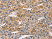 The image on the left is immunohistochemistry of paraffin-embedded Human liver cancer tissue using CSB-PA289378(SNTA1 Antibody) at dilution 1/20, on the right is treated with synthetic peptide. (Original magnification: ×200)