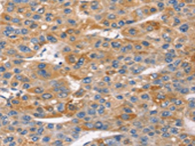 The image on the left is immunohistochemistry of paraffin-embedded Human liver cancer tissue using CSB-PA289378(SNTA1 Antibody) at dilution 1/20, on the right is treated with synthetic peptide. (Original magnification: ×200)