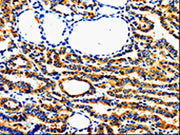 The image on the left is immunohistochemistry of paraffin-embedded Human thyroid cancer tissue using CSB-PA289421(AIMP2 Antibody) at dilution 1/50, on the right is treated with fusion protein. (Original magnification: ×200)