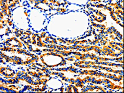 The image on the left is immunohistochemistry of paraffin-embedded Human thyroid cancer tissue using CSB-PA289421(AIMP2 Antibody) at dilution 1/50, on the right is treated with fusion protein. (Original magnification: ×200)