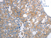 The image on the left is immunohistochemistry of paraffin-embedded Human breast cancer tissue using CSB-PA289440(SLC12A6 Antibody) at dilution 1/30, on the right is treated with synthetic peptide. (Original magnification: ×200)