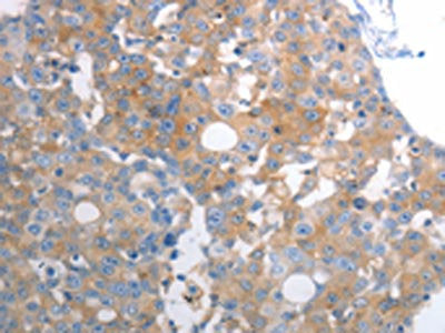 The image on the left is immunohistochemistry of paraffin-embedded Human breast cancer tissue using CSB-PA289440(SLC12A6 Antibody) at dilution 1/30, on the right is treated with synthetic peptide. (Original magnification: ×200)